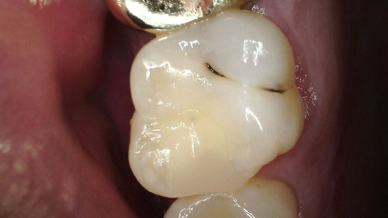 Klinisk billede taget med CS 1300