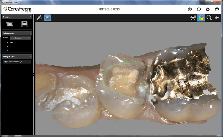 CS 3600 automatisk 3D-marginlinje i CS ScanFlow