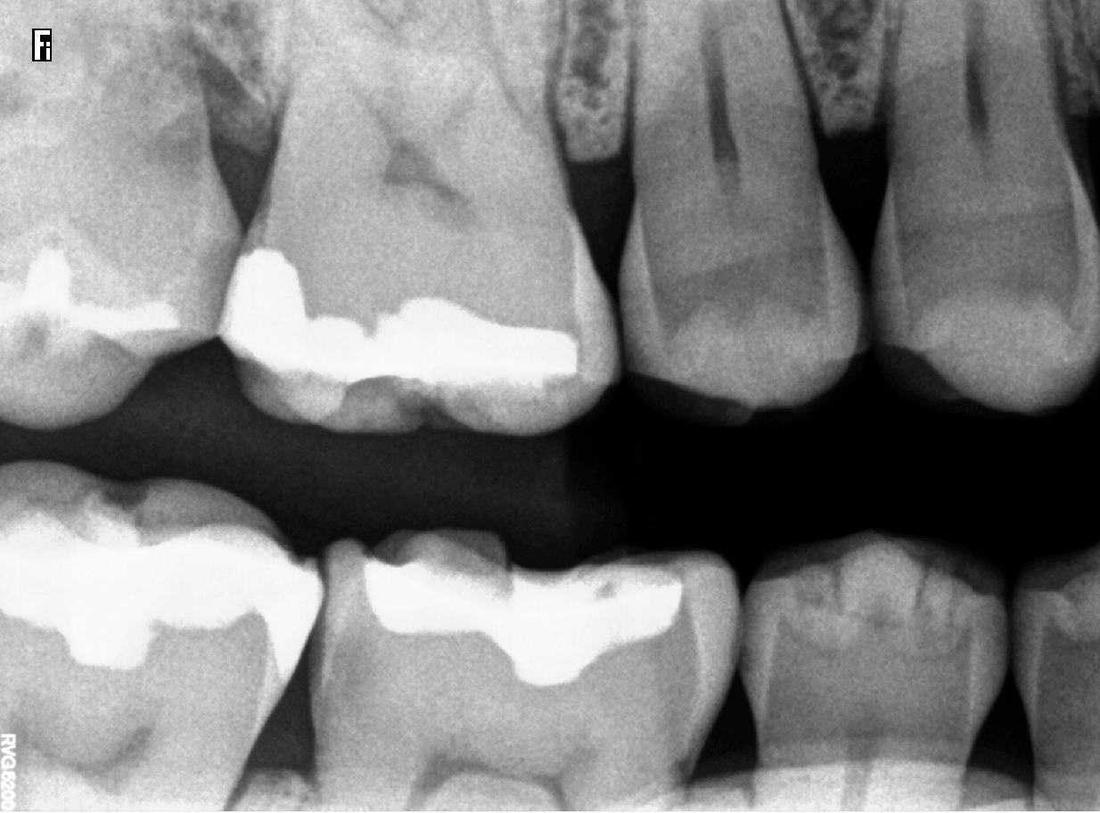 RVG 5200 bitewing-billede — approksimale karies og fyllinger