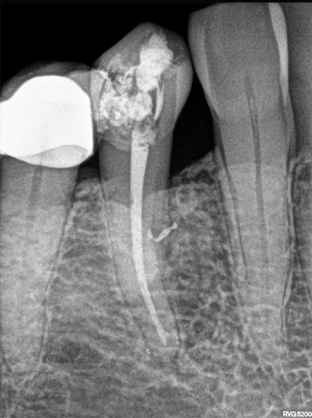 RVG 5200 periapikalt billede — endodontisk behandling med rodkanalinstrument