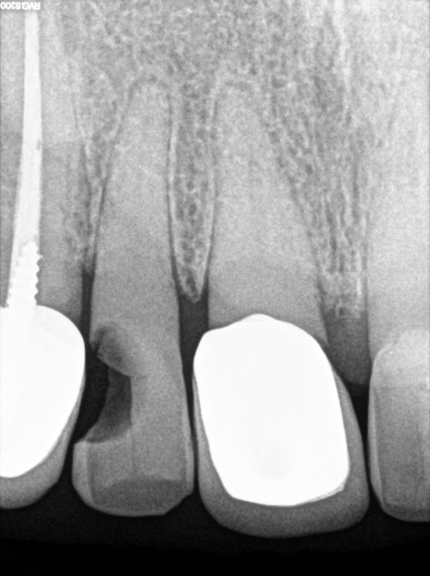 RVG 5200 periapikalt billede — rodfyldning og kronekonstruktion