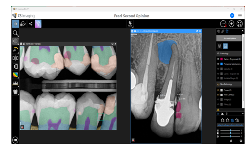 CS Imaging med Pearl Second Opinion AI — automatisk markering af caries og knogletab