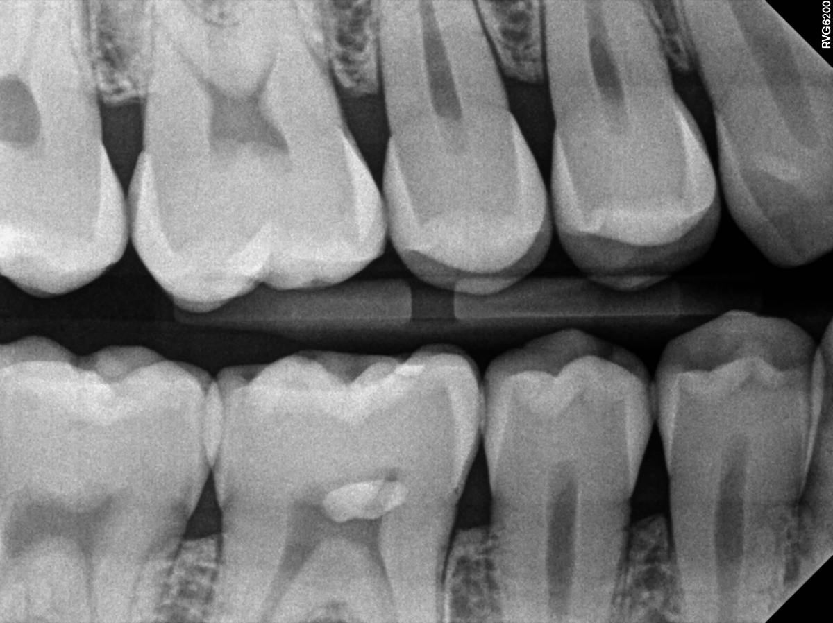 RVG 6200 bitewing-billede — approksimale karies og fyllinger