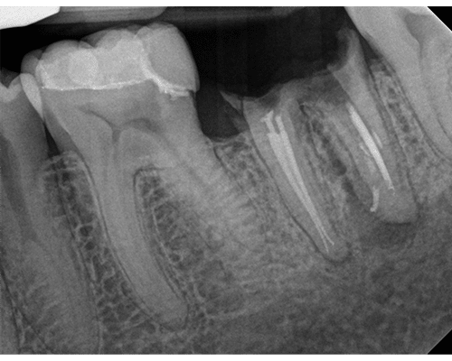 RVG 6200 periapikalt billede — fraktureret krone
