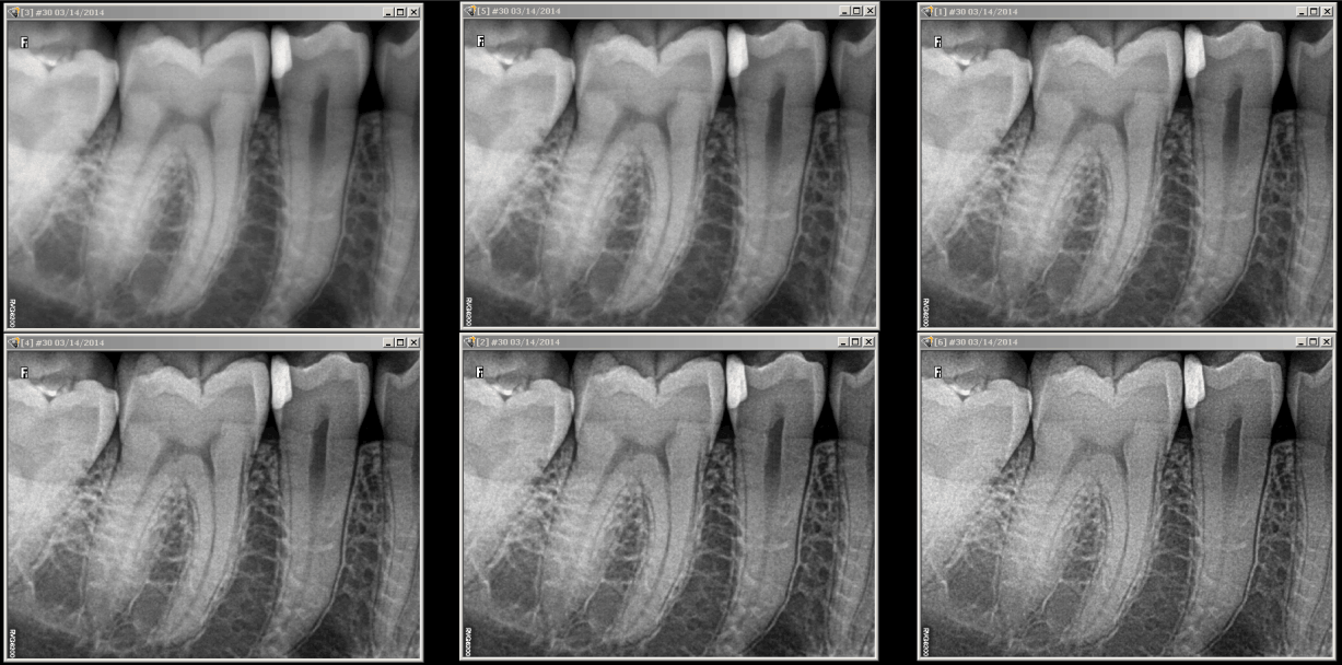 Matrix af seks RVG 6200 kliniske billeder — konsistent høj billedkvalitet