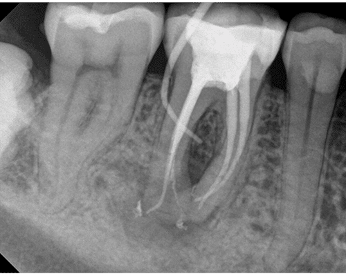 RVG 6200 periapikalt billede — rodkanalfyldning