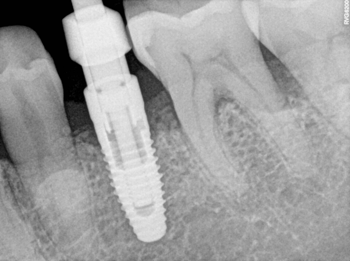 RVG 6200 periapikalt billede — implantatskrue og knoglegrænse