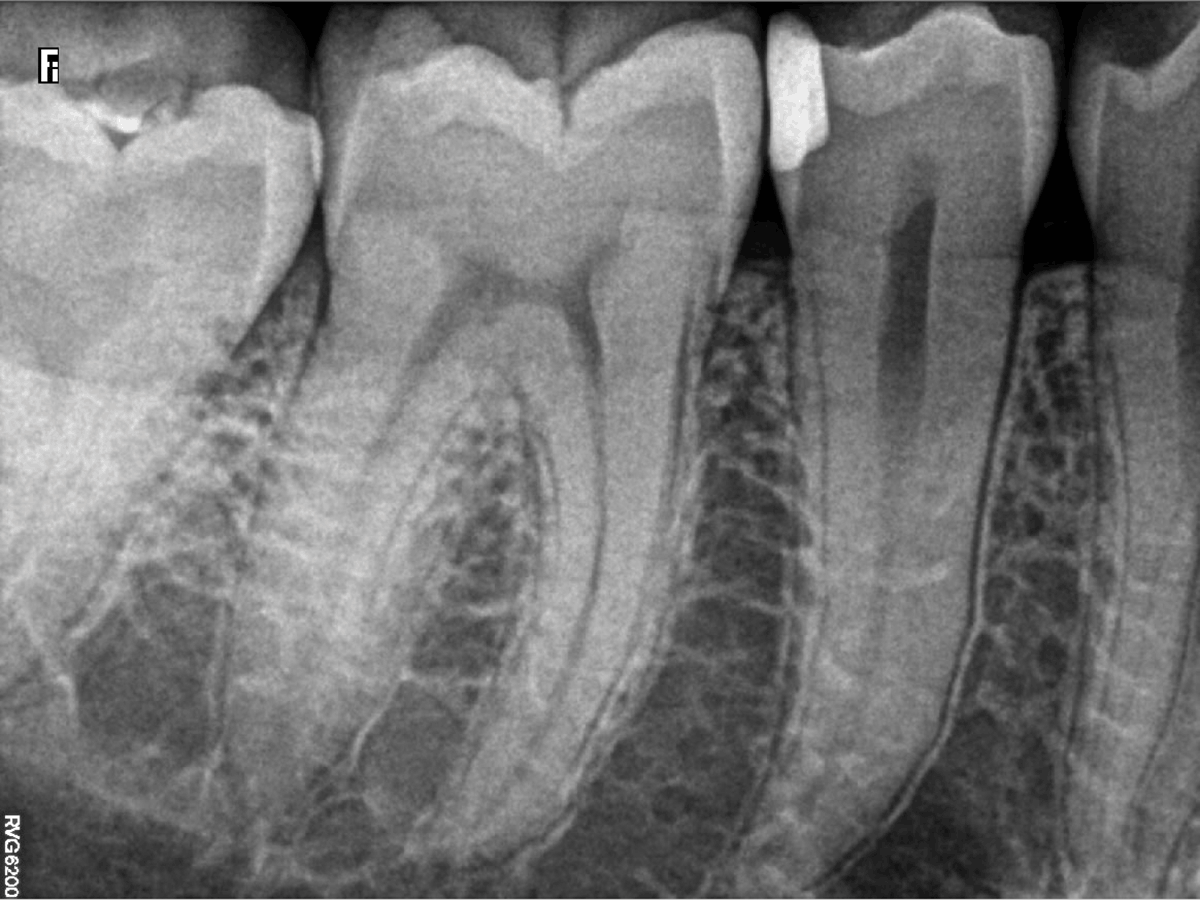 RVG 6200 periapikalt billede — tandens sideflader