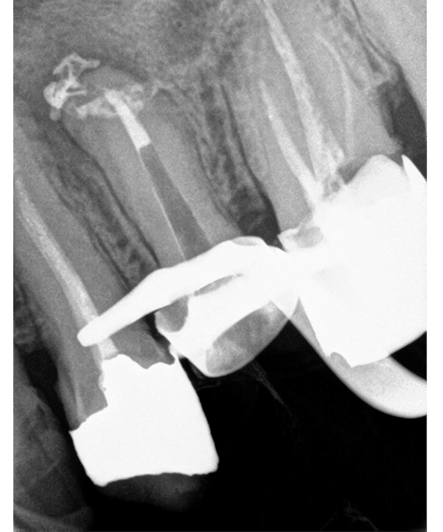 RVG 6200 periapikalt billede — metal restaurering