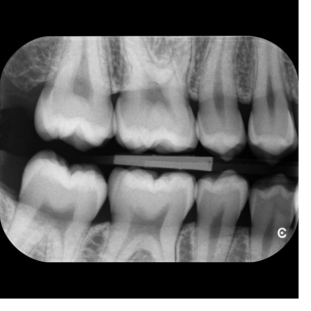 CS 7600 bitewing-billede — bagkindtænder