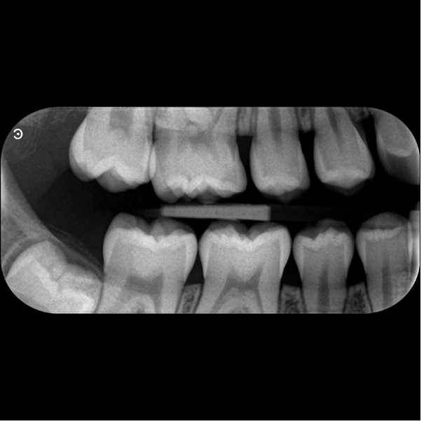 CS 7600 bitewing-billede — variant