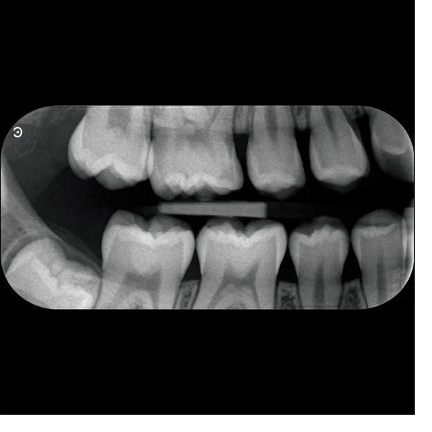 CS 7600 bitewing-billede — variant