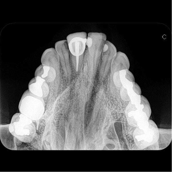 CS 7600 okklusalt billede — overkæbe