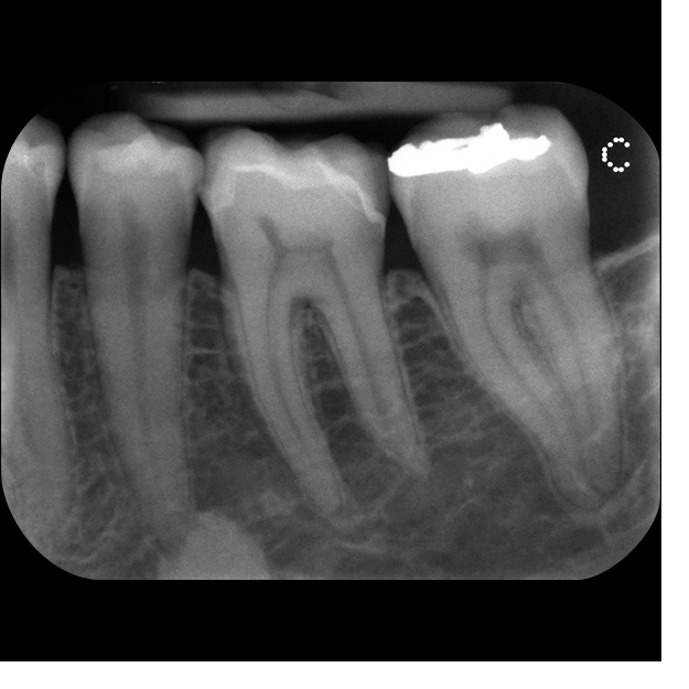 CS 7600 periapikalt billede — tandrod og knoglekam