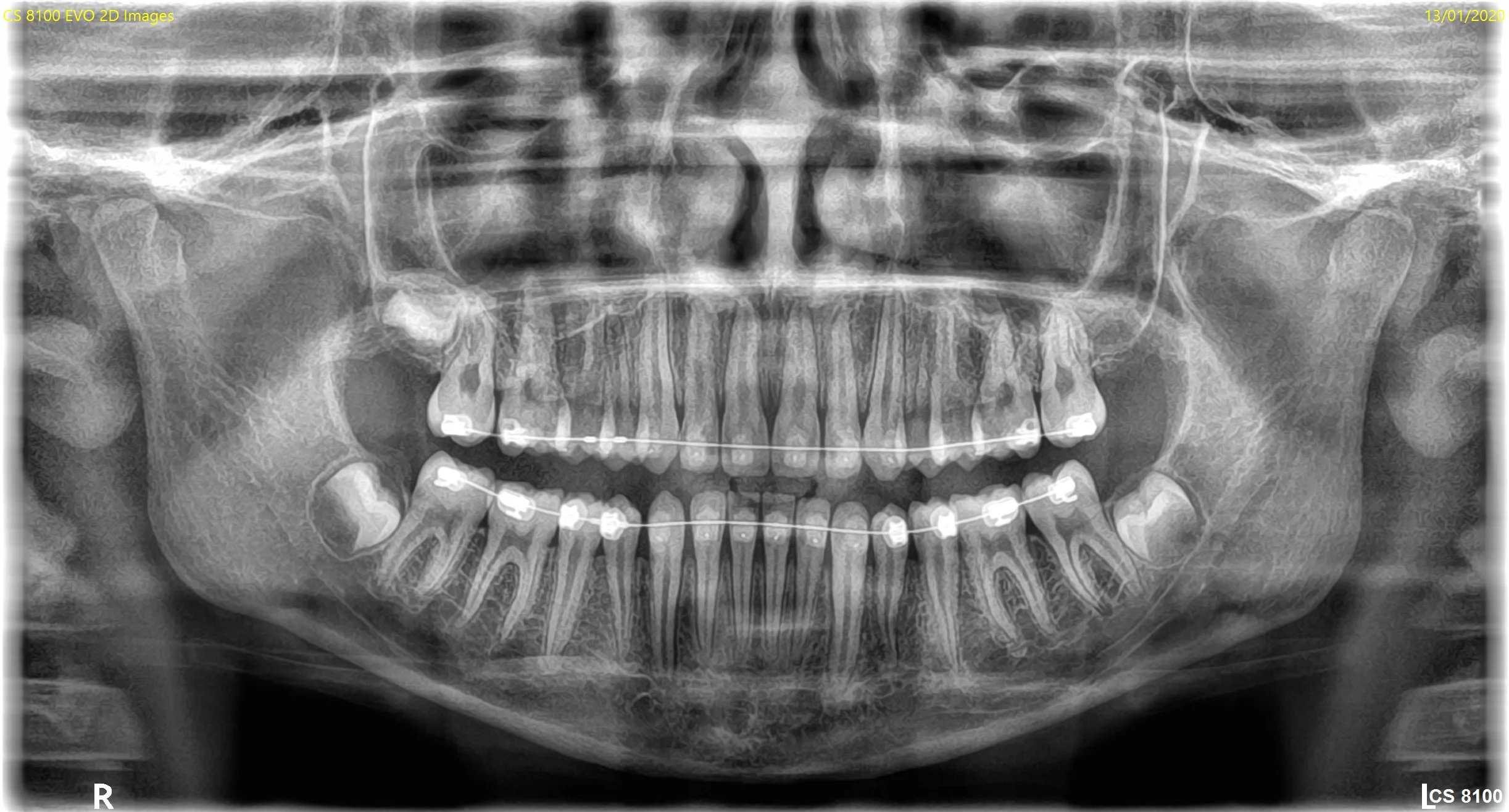 CS 8100SC panoramabillede — voksen