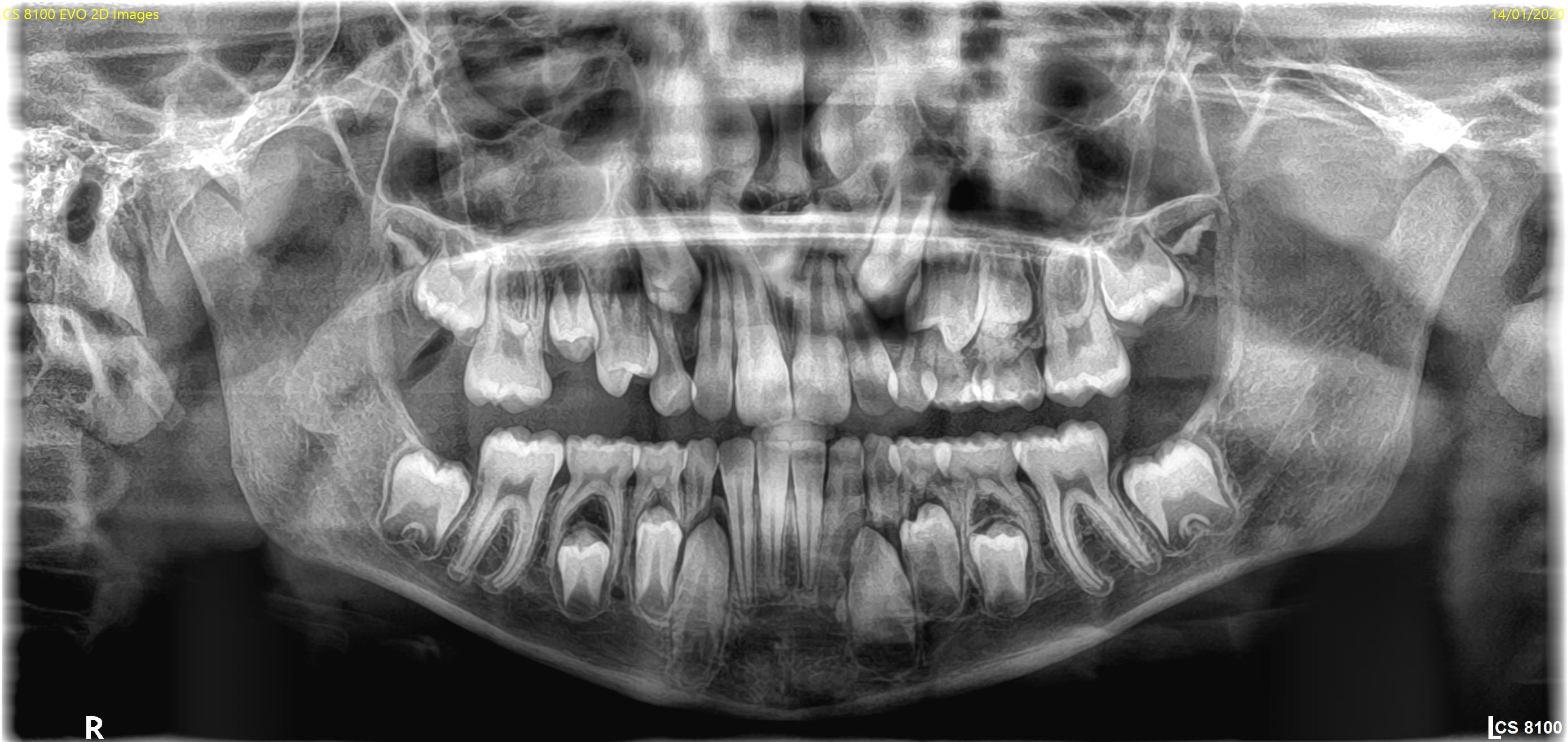 CS 8100SC pædiatrisk optagelse