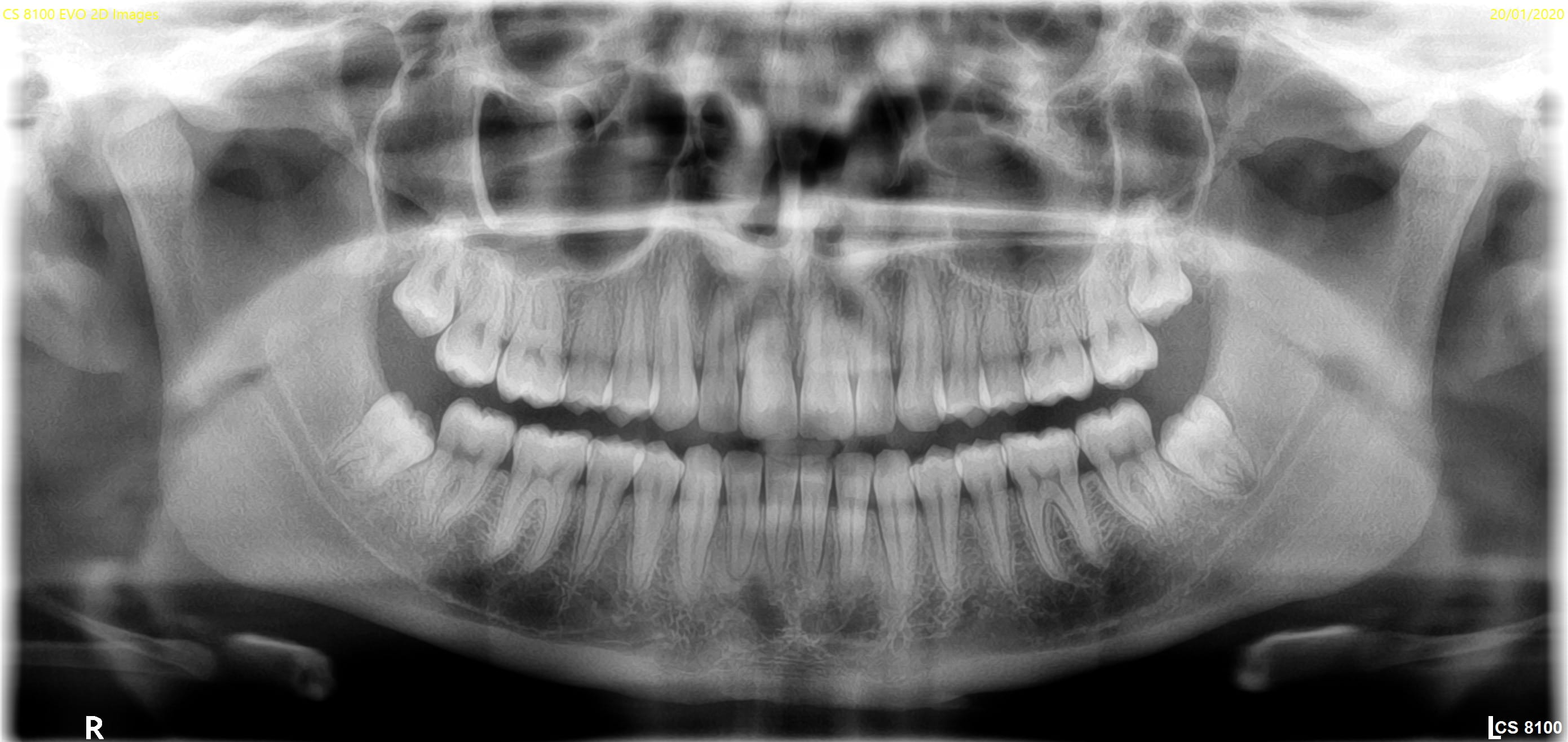 CS 8100 panoramabillede — voksen variant 2