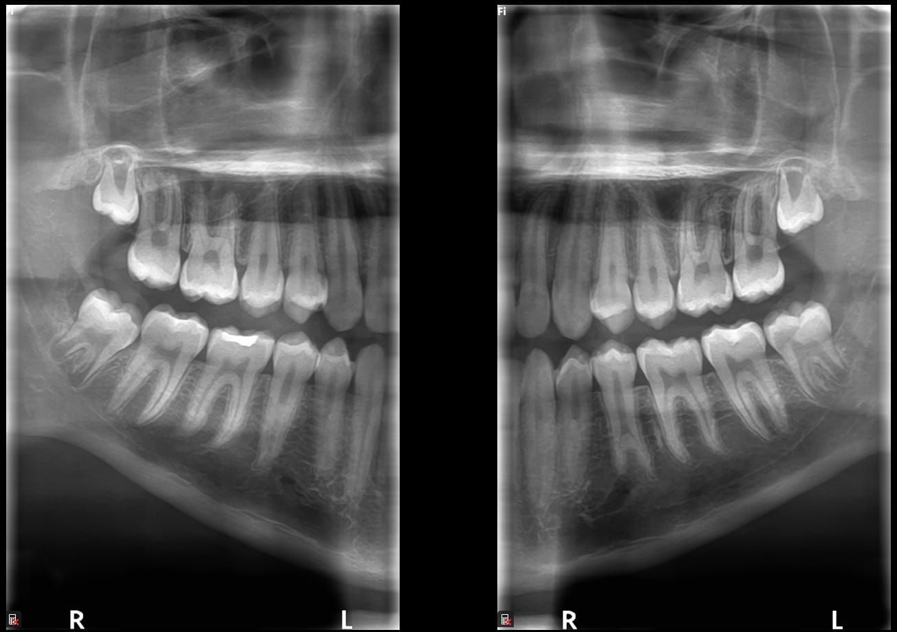 CS 8100 ekstraoral bitewing