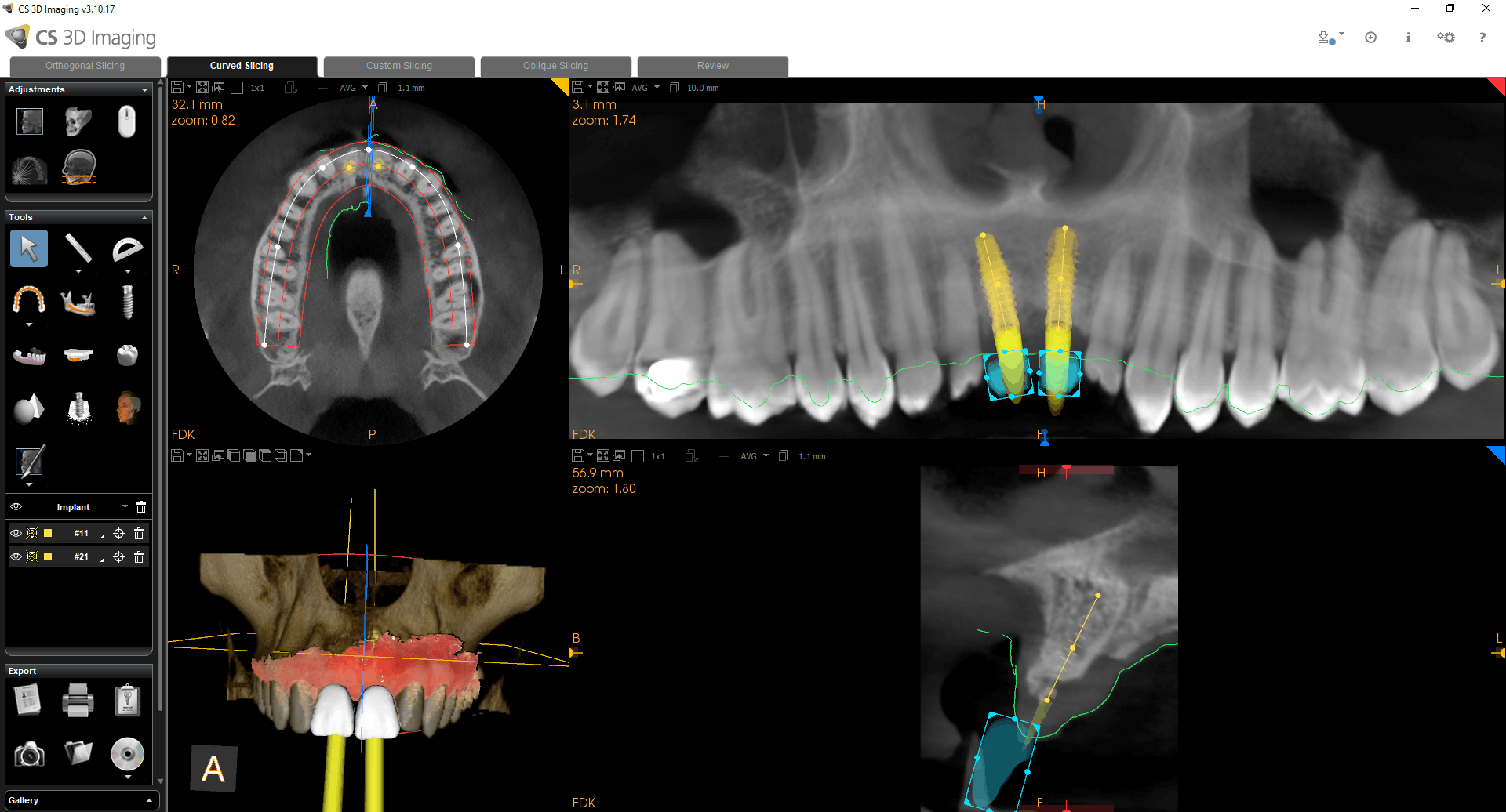 PDIP Implantatplanlægning