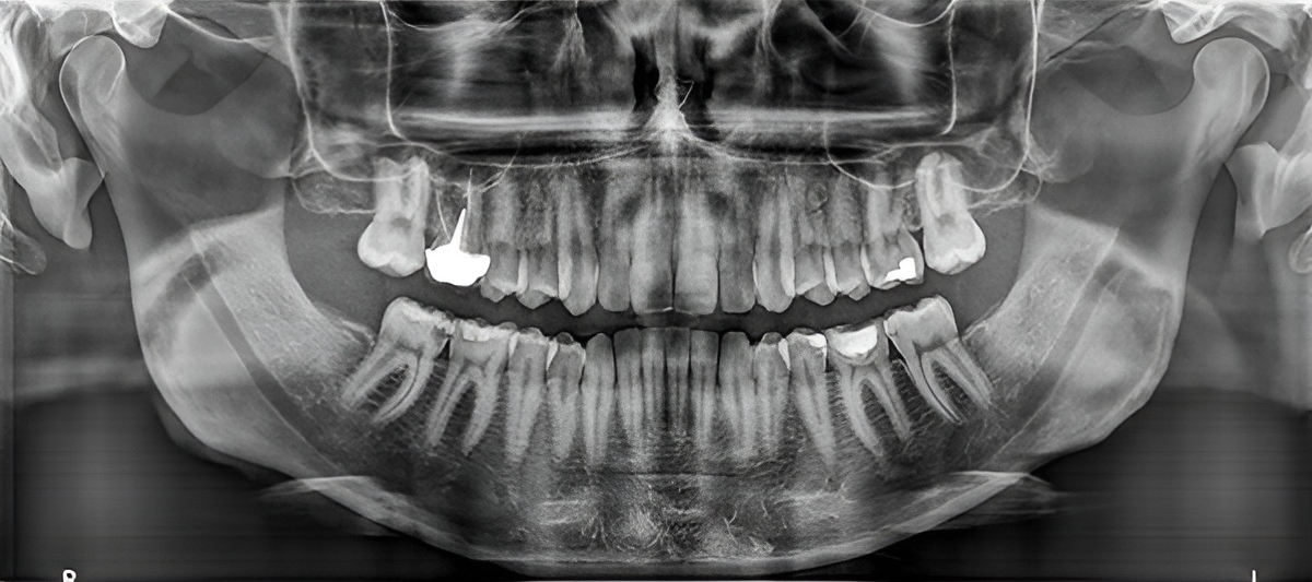 CS 8100 panoramabillede modalitet