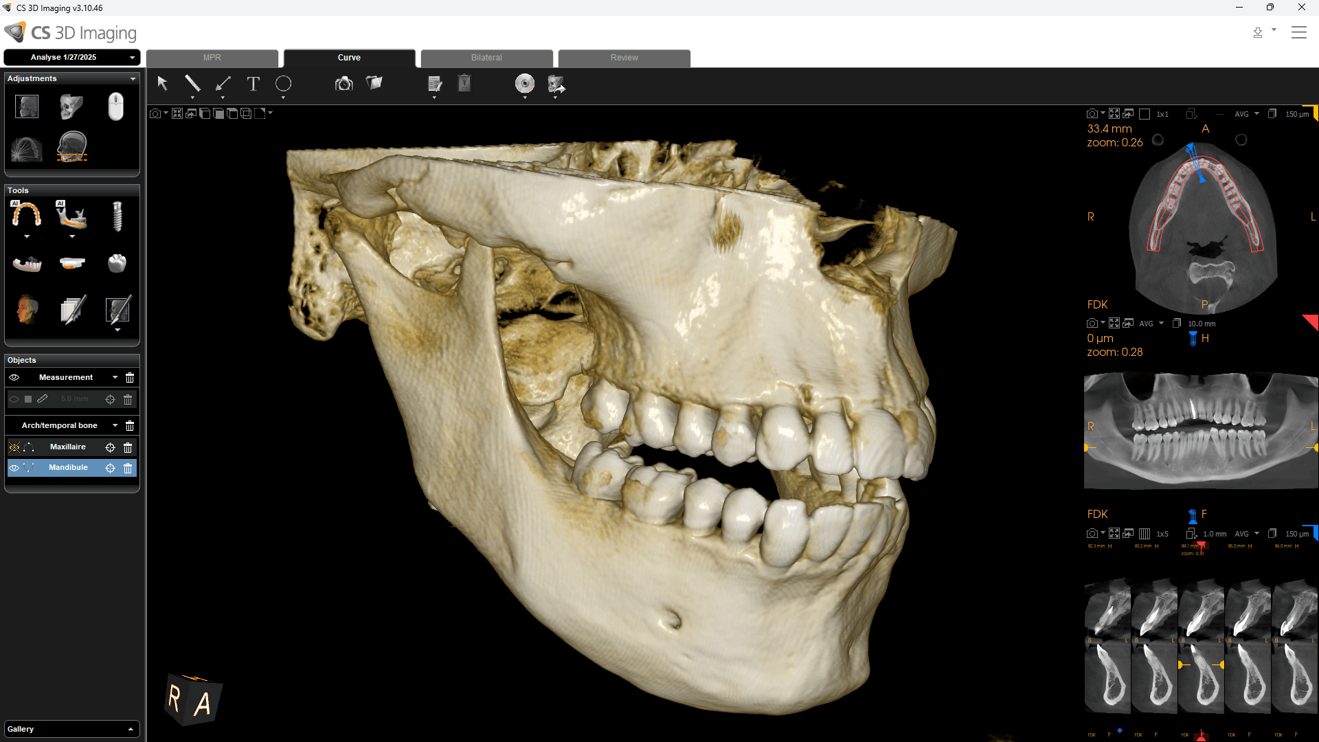 CS 8200 3D 16×10 cm FOV — lateral