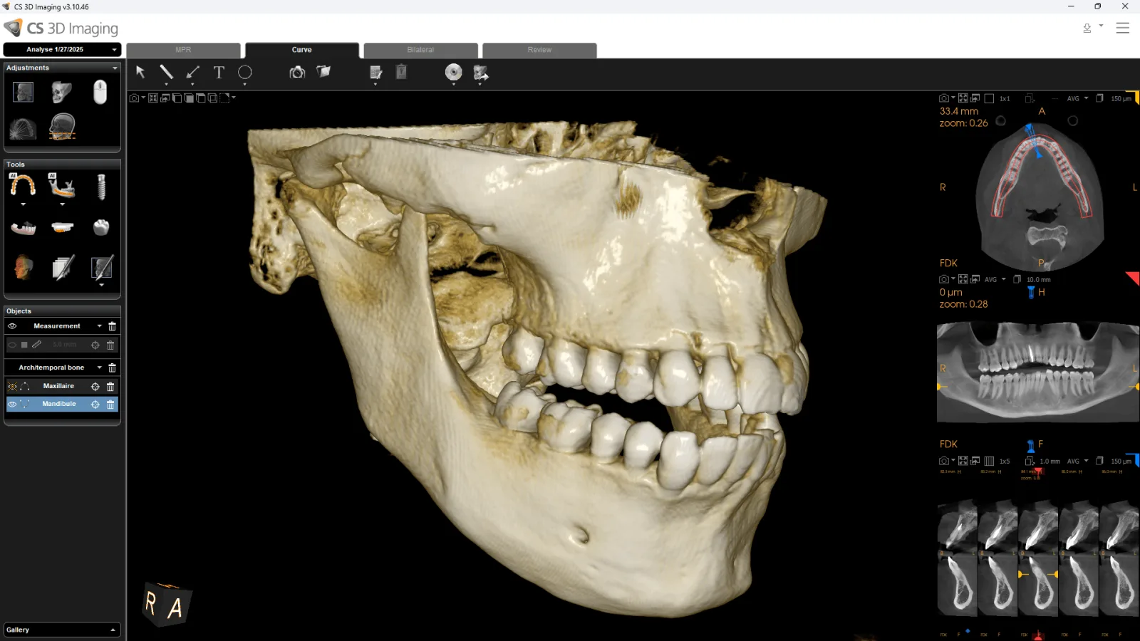 CS 8200 3D 16×10 cm FOV — lateral