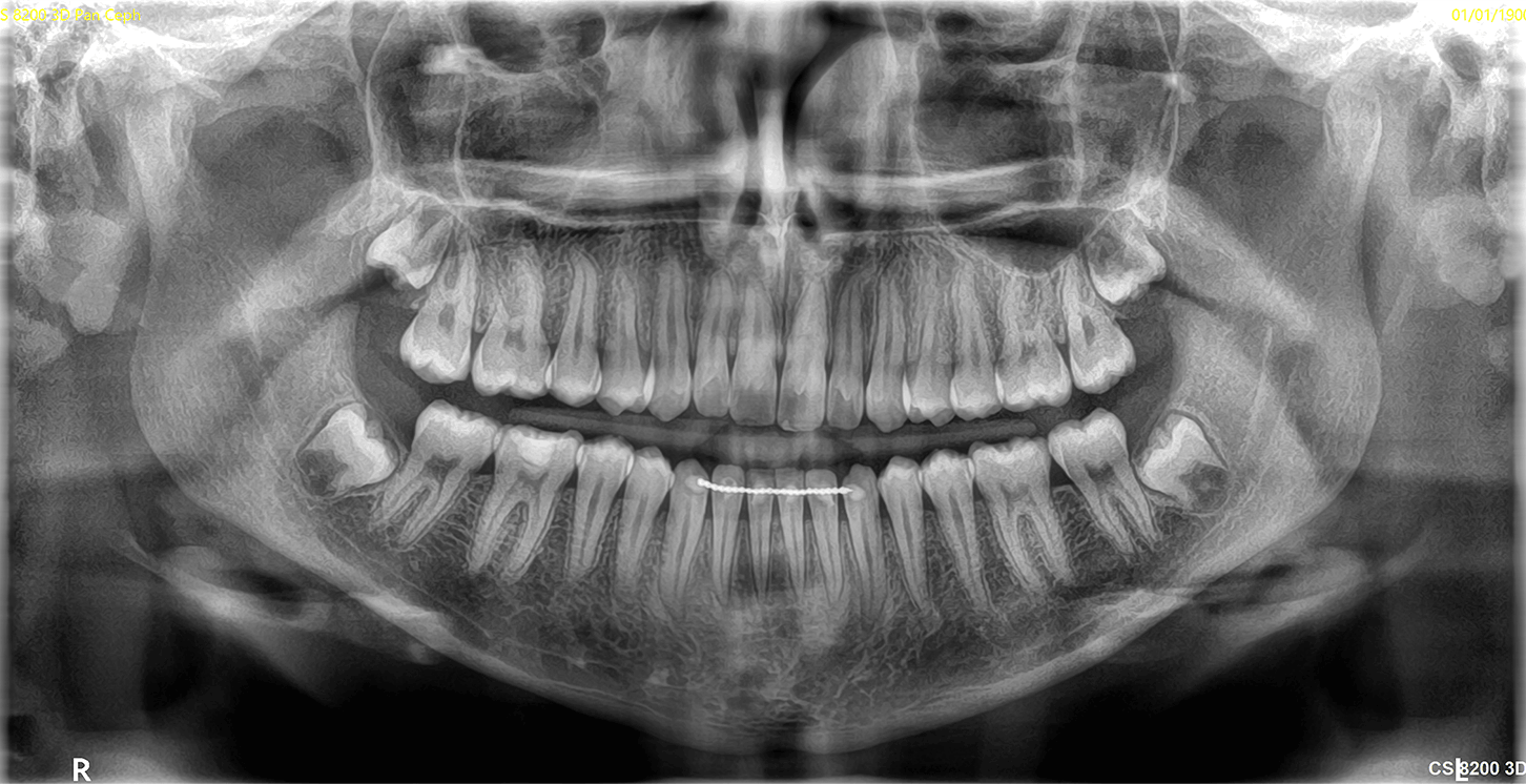 CS 8200 3D panoramabillede variant 2