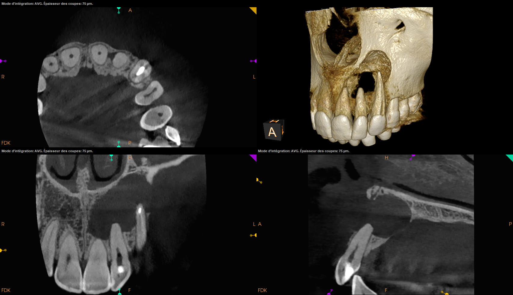 CS 8200 3D CBCT-optagelse