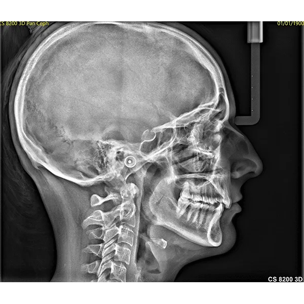 Cephalometrisk optagelse fra CS 8200 3D