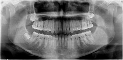 CS 9000 3D panoramabillede