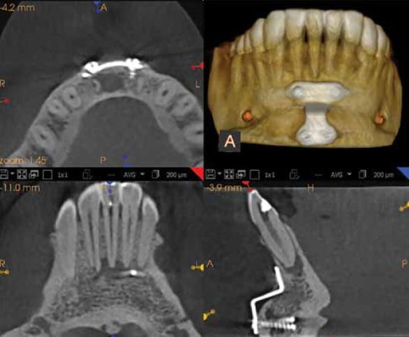 CS 9000 3D CBCT-rekonstruktion i software