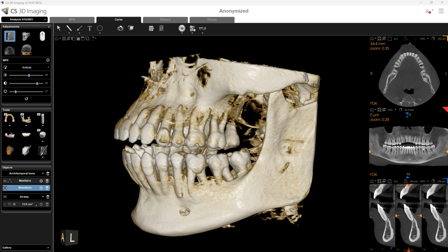 CS 9600 fuldt CBCT-volumen