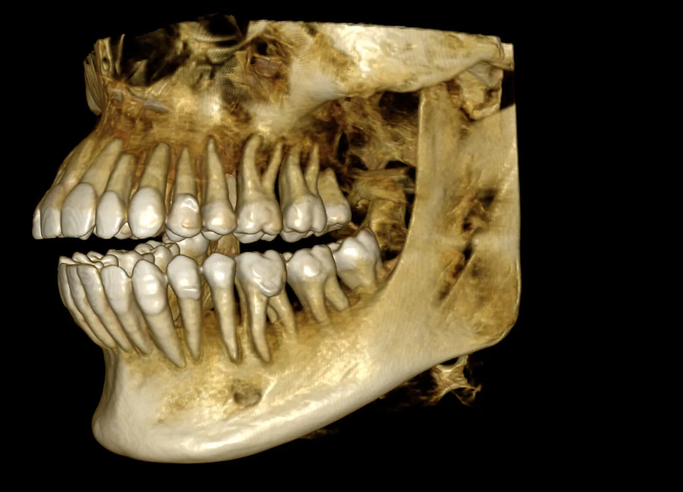 CBCT 3D-rekonstruktion af kæbe og tænder