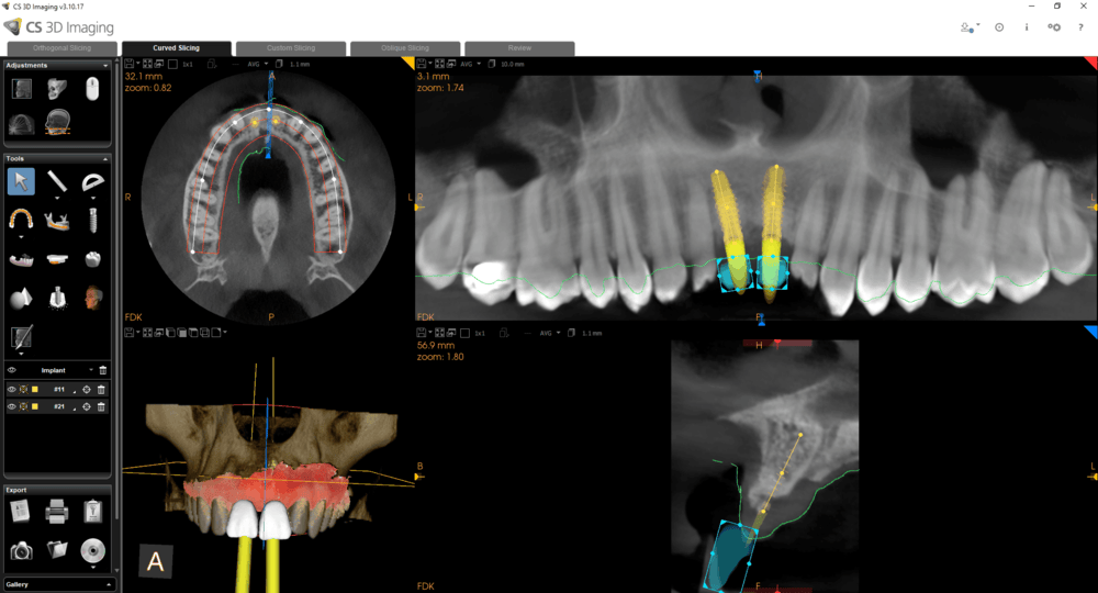 CS 3D Imaging — klinisk arbejdsgang med implantplanlægning