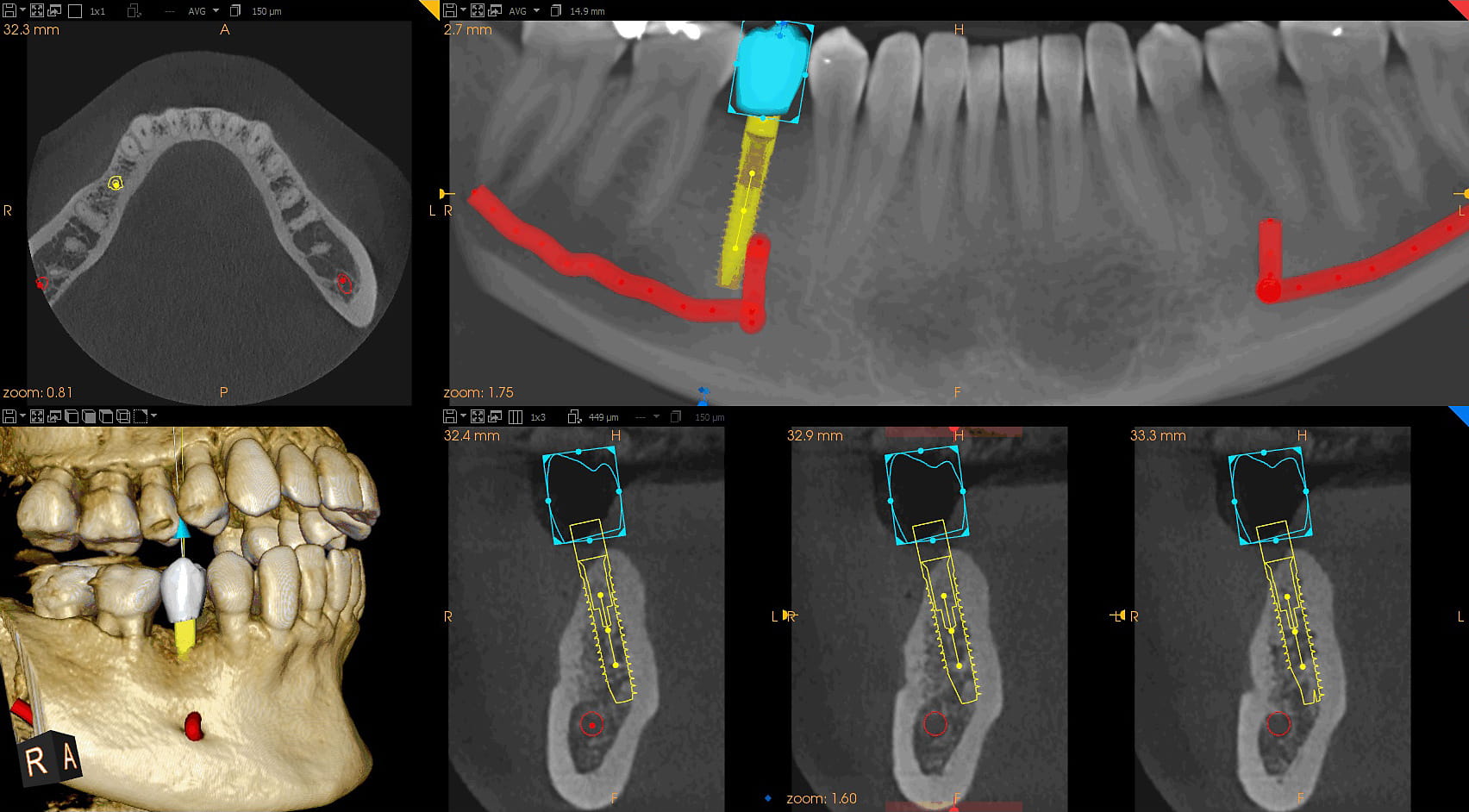 CS 3D Imaging — implantplanlægning med nervekanal-farvemarkering