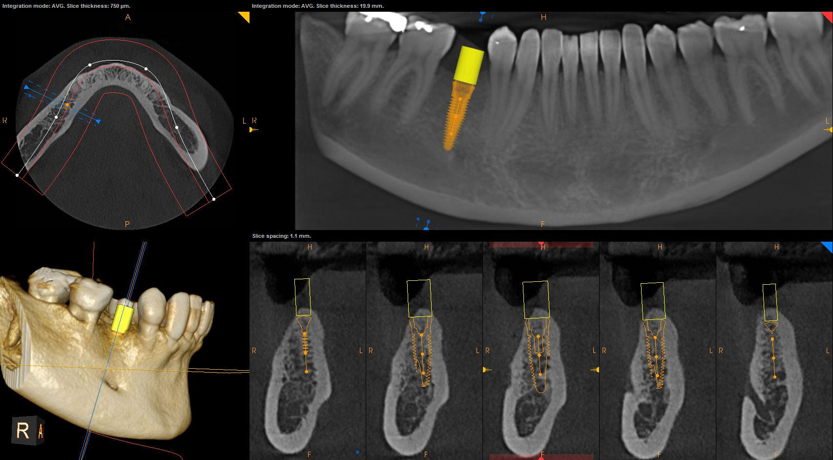 CS 3D Imaging — mandibulær implantplanlægning med knoglekvalitetsvurdering